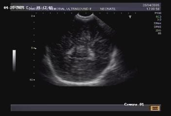 Nuero sonography image